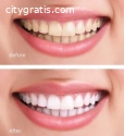 Best Teeth Whitening in Homestead FL