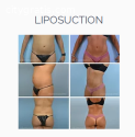 Breast Augmentation Orlando