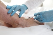 varicose vein treatment In New Jersey